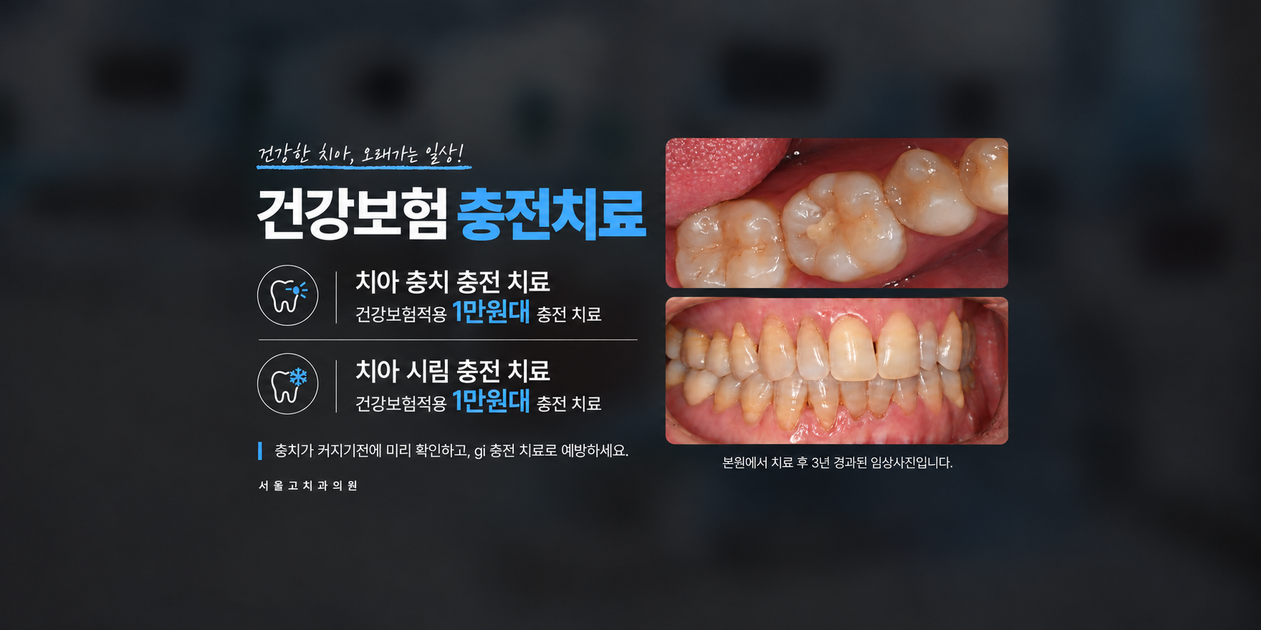 건강보험 Gi 충치치료-글래스아이오노머